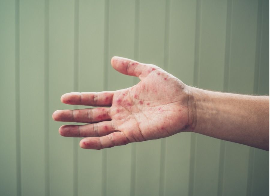 Hand Foot Mouth Disease   Young Man With Hand Foot And Mouth Disease Picture Id915139866 (1) 